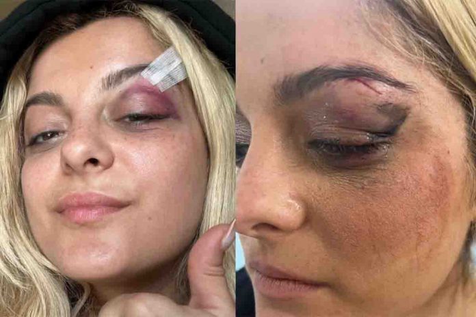 Bebe Rexha, e i segni evidenti della folle aggressione